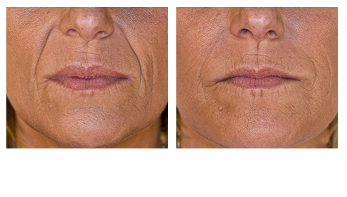 juvederm-04.jpg juvederm-04.jpg